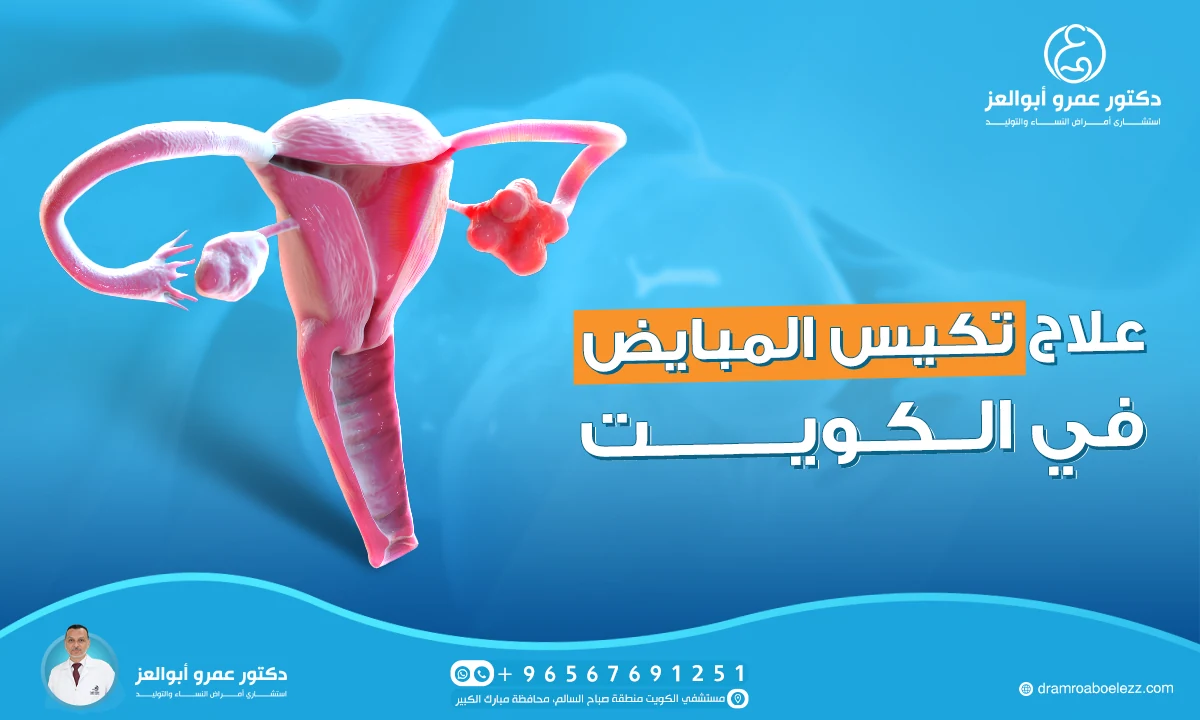 أفضل دكتور لعلاج تكيس المبايض في الكويت