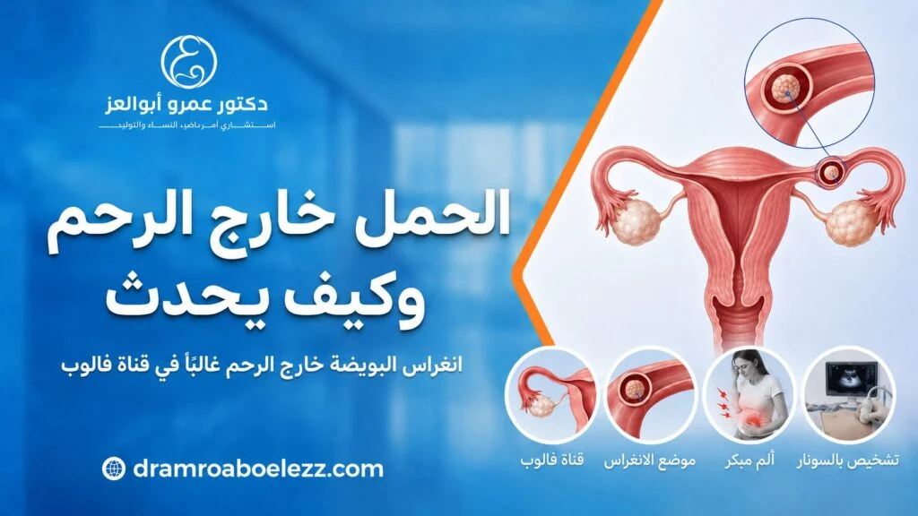 رسم طبي يوضح الحمل خارج الرحم وكيف يحدث عند انغراس البويضة خارج تجويف الرحم غالبًا داخل قناة فالوب.