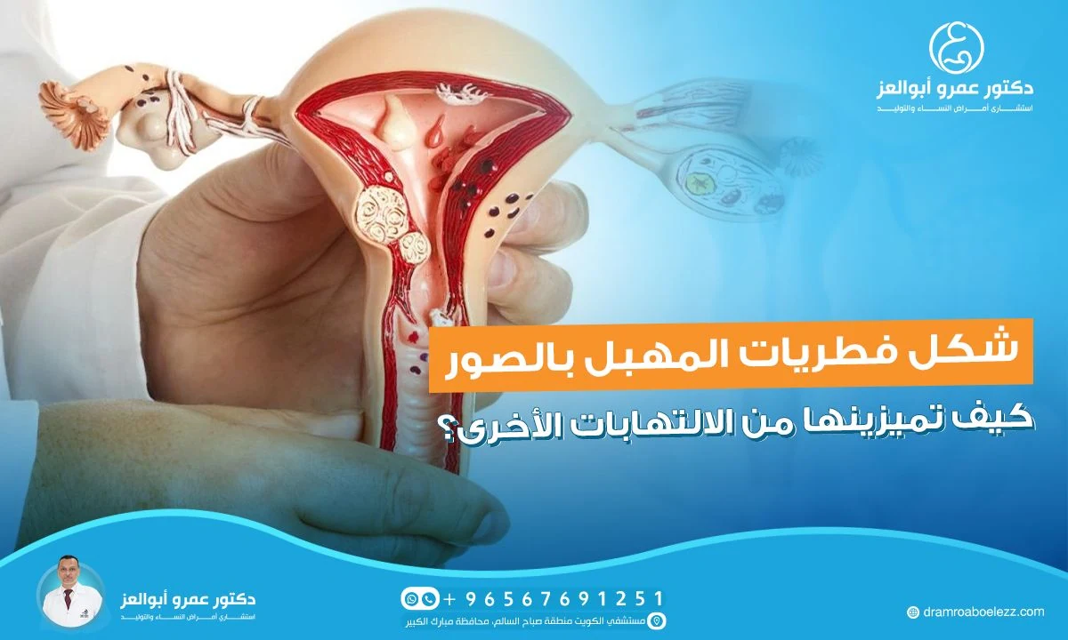 شكل فطريات المهبل بالصور: كيف تميزينها من الالتهابات الأخرى؟