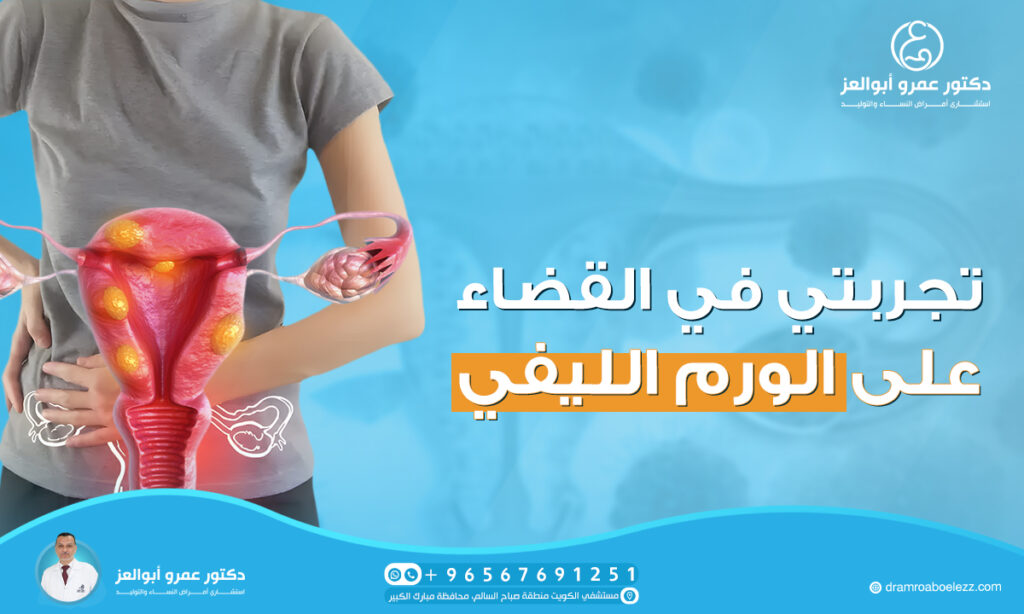 تجربتي في القضاء على الورم الليفي