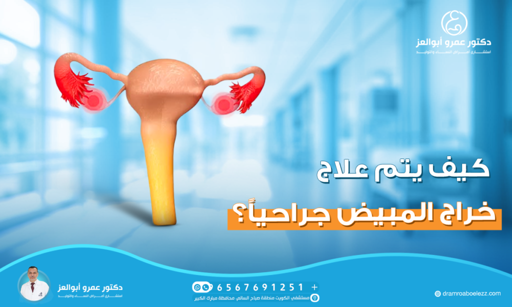 كيف يتم علاج خراج المبيض جراحياً؟